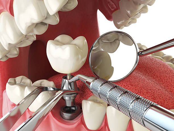 Best Emergency Tooth Extraction in Oakley, CA